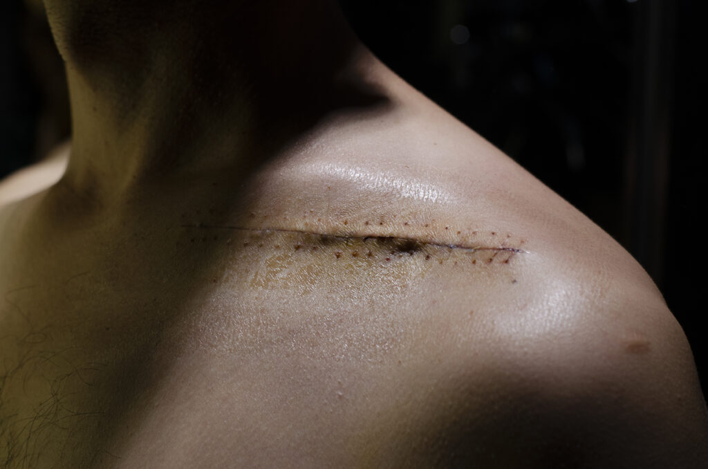 brazgotine po operaciji